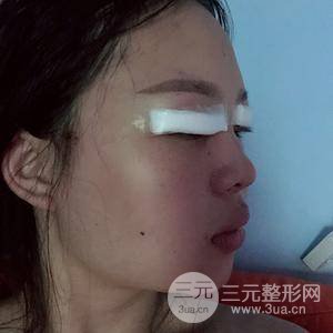 眼部吸脂