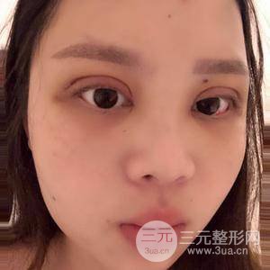 眼部吸脂