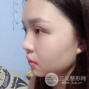 眼部吸脂