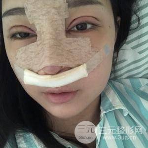 鼻子综合整形