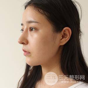鼻子综合整形