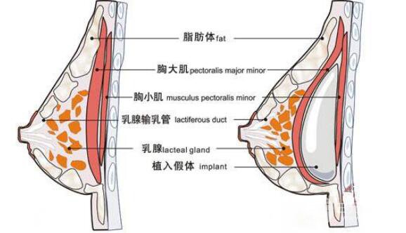成都假体隆胸成好吗?恢复期是多久?