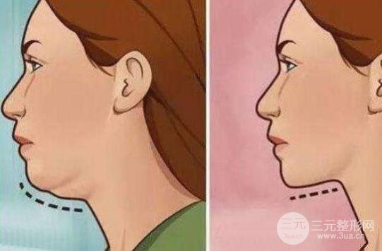 成都双下巴吸脂价格多少?费用贵吗?
