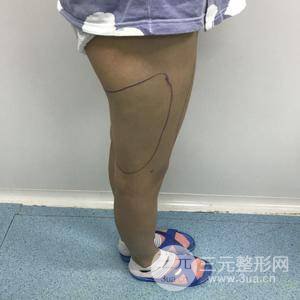 减肥吸脂手术