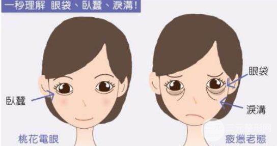 成都祛眼袋费用大概要花多少钱