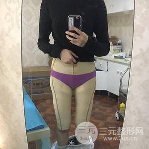 吸脂瘦大腿
