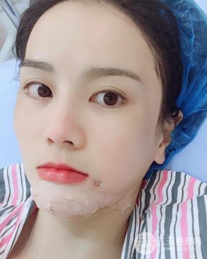 假体隆下巴