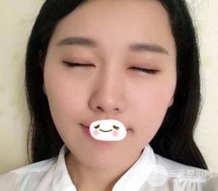 成都双眼皮修复贵不贵？附真实案例及修复价格