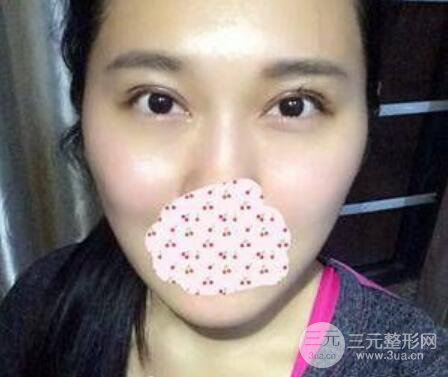 成都双眼皮修复贵不贵？附真实案例及修复价格
