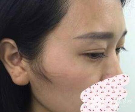 成都双眼皮修复贵不贵？附真实案例及修复价格