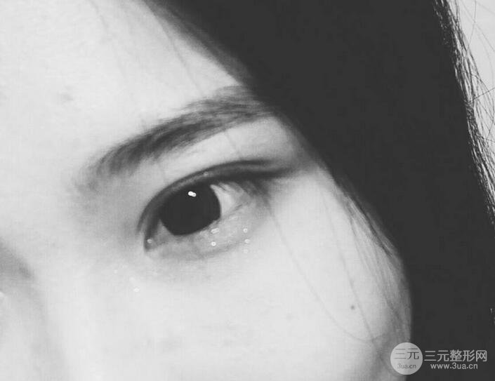 成都埋线双眼皮多少钱?果自然吗?能维持多久?