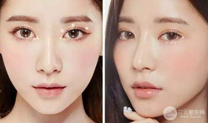 成都开内外眼角分别是什么价格?哪个贵些?