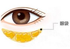 成都祛眼袋要多少钱?价格范围一般是多少?