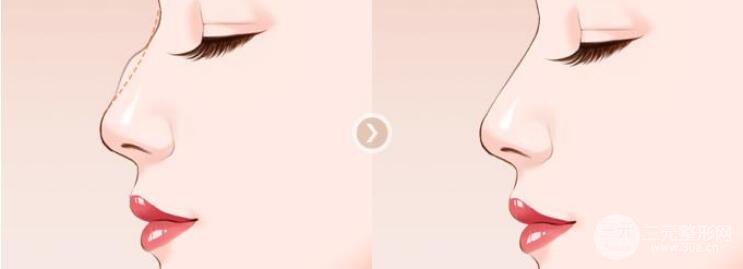 成都做驼峰鼻矫正手术一般要多少钱?