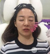 成都埋埋提升多少钱?附上真人案例前后对比照片~ 成都埋埋提升多少钱?附上真人案例前后对比照片~