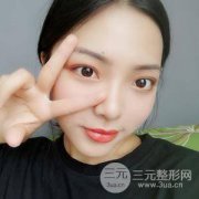 脂肪面颊部填充35天真实案例果图分享