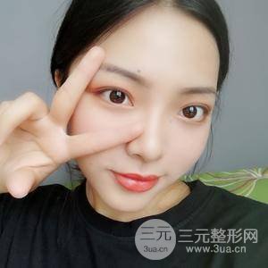 脂肪面颊部填充