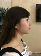 成都垫下巴多少钱?膨体垫下巴前后对比照片分享~ 成都垫下巴多少钱?膨体垫下巴前后对比照片分享~