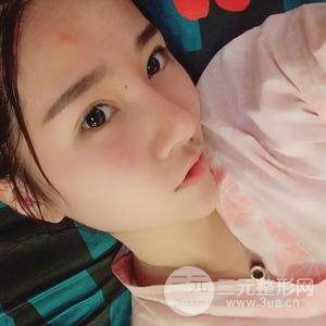 埋线双眼皮