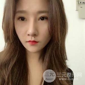 埋线双眼皮
