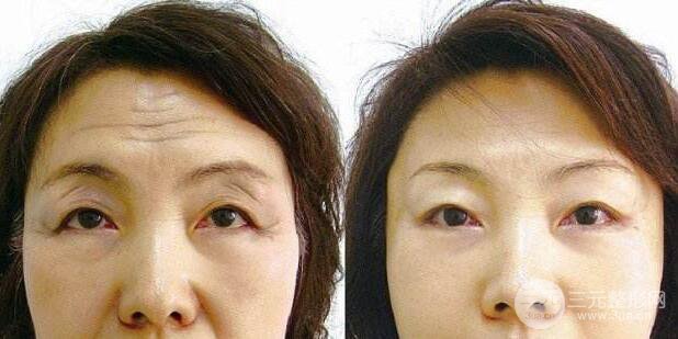 成都去抬头纹要多少钱?