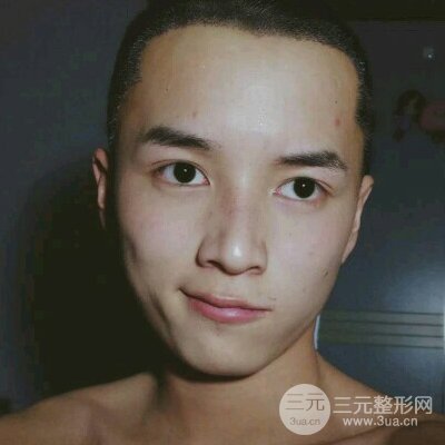 成都恒博程宗玉鬓角种植案例前后对比照片分享