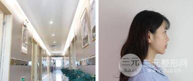 自体脂肪填充额头