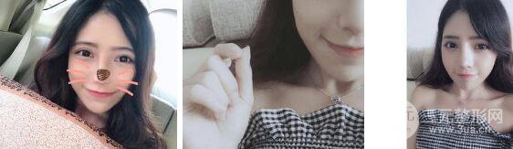 自体脂肪填充额头