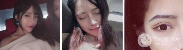 自体脂肪填充额头