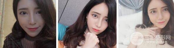 自体脂肪填充额头