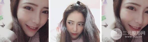 自体脂肪填充额头