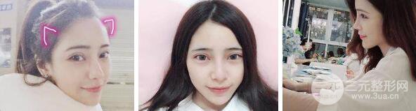 自体脂肪填充额头