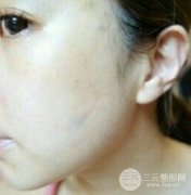 成都锯齿.线除皱果原来这么好 45天就让我恢复年轻美丽