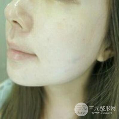 成都锯齿.线除皱