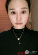 成都种发际线果图分享 种发际线术后120天恢复日记 成都种发际线果图分享 种发际线术后120天恢复日记