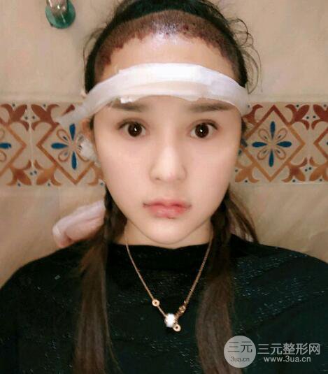 种发际线果图