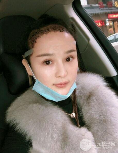 种发际线果图