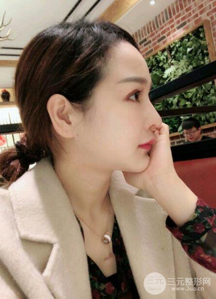 种发际线果图