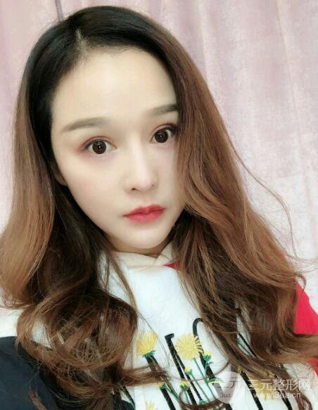 种发际线果图