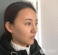 眉弓填充怎么样？小姐姐分享在广州华美做眉弓填充经历