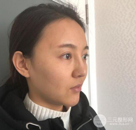 眉弓填充