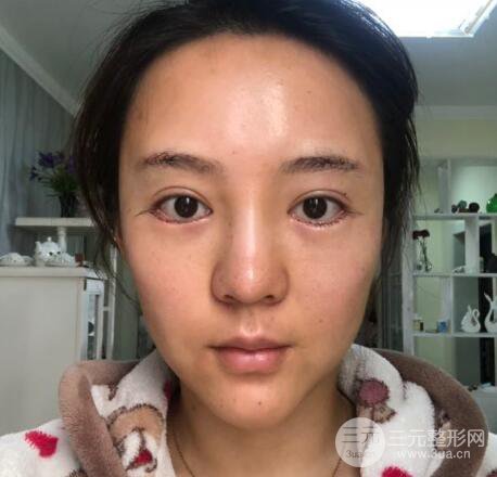 眉弓填充