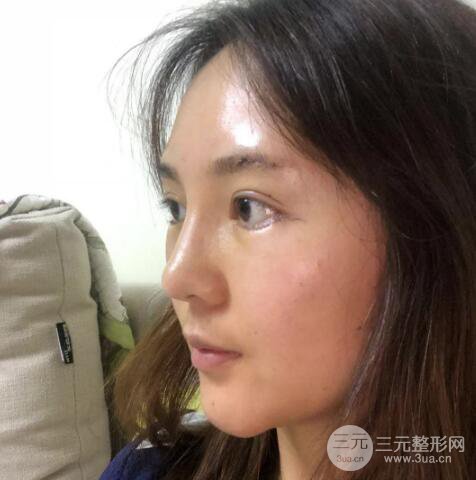 眉弓填充