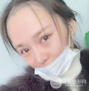 眉弓填充