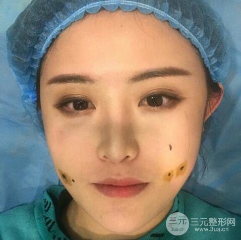 重庆华美酒窝整形价格