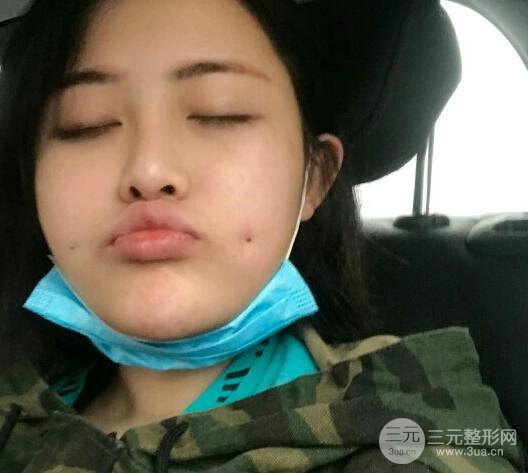 重庆华美酒窝整形价格