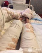 广州美莱大腿环形吸脂手术怎么样 80天Z终果图呈上