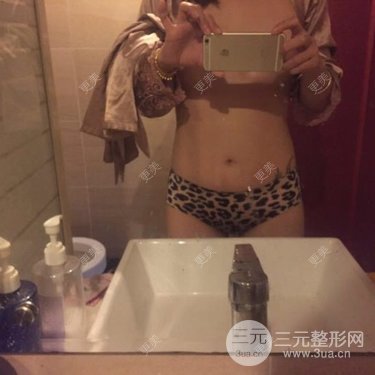 大腿环形吸脂