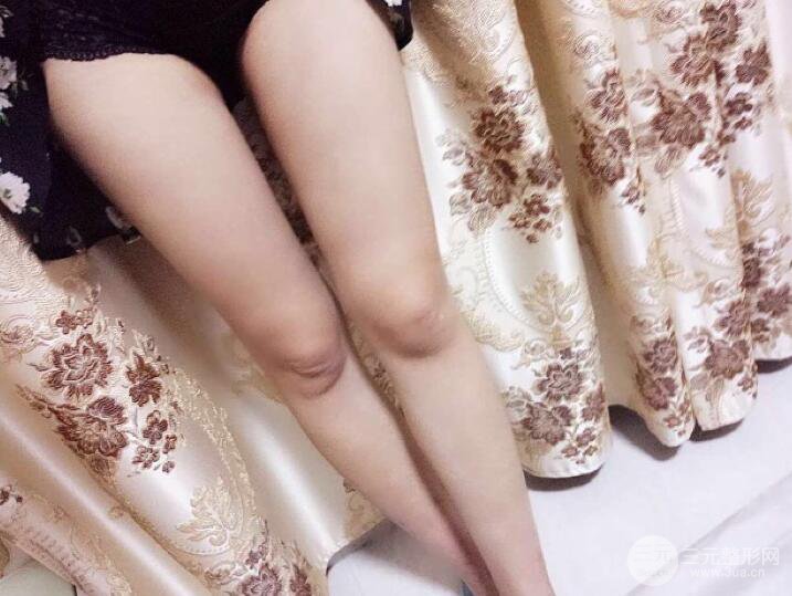 大腿环形吸脂