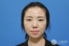 北京膨体隆鼻哪好?奉上小姐姐在北京膨体隆鼻案例图 北京膨体隆鼻哪好?奉上小姐姐在北京膨体隆鼻案例图